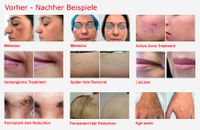 Dermatologische Laseranwendungen - vorher - nachher